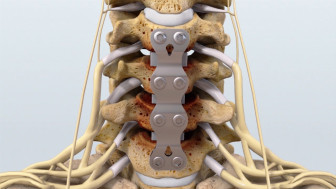 Cervical Spine Discectomy and Fusion